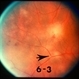 Posterior Uveitis